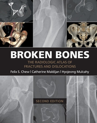 Broken Bones: The Radiologic Atlas of Fractures and Dislocations by Chew, Felix S.