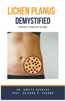 Lichen Planus Demystified Doctors Secret Guide by Kashyap, Ankita