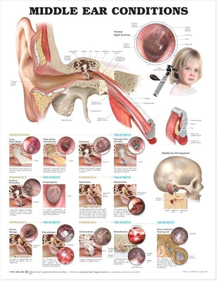 Middle Ear Conditions Anatomical Chart by Anatomical Chart Company