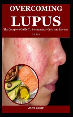 Overcoming Lupus: The Complete Guide To Permanently Cure And Reverse Lupus by Cesar, John