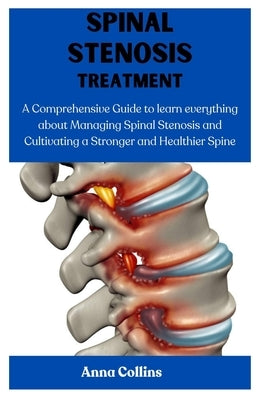 Spinal Stenosis Treatment: A Comprehensive Guide to learn everything about Managing Spinal Stenosis and Cultivating a Stronger and Healthier Spin by Collins, Anna