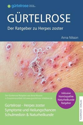 Gürtelrose - Der große Ratgeber zu Herpes zoster: Schulmedizin + Naturheilkunde by Nilsson, Anna