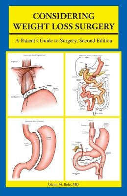 Considering Weight Loss Surgery: A Patient's Guide to Surgery, Second Edition by Ihde MD, Glenn M.