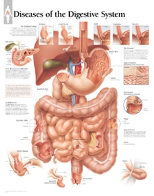 Diseases of Digestive System Chart: Laminated Wall Chart by Scientific Publishing