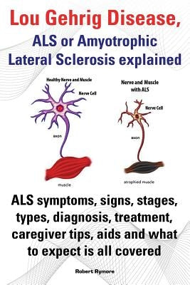 Lou Gehrig Disease, ALS or Amyotrophic Lateral Sclerosis Explained. ALS Symptoms, Signs, Stages, Types, Diagnosis, Treatment, Caregiver Tips, AIDS and by Rymore, Robert