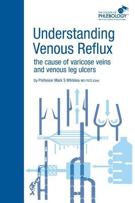 Understanding Venous Reflux the Cause of Varicose Veins and Venous Leg Ulcers: Varicose veins and venous leg ulcers by Whiteley, Mark S.