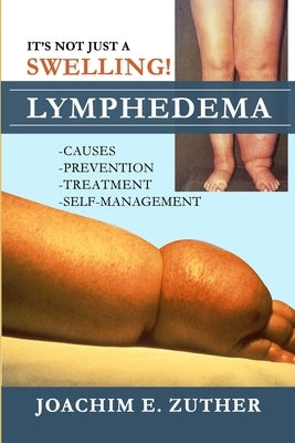 It's Not Just a Swelling! Lymphedema: Causes, Prevention, Treatment, Self-Management by Zuther, Joachim