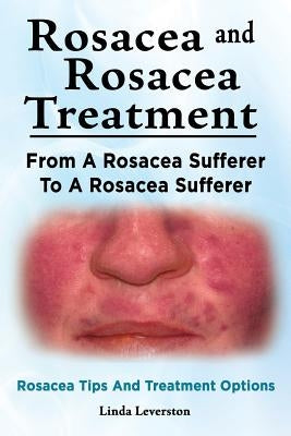 Rosacea and Rosacea Treatment. From A Rosacea Sufferer To A Rosacea Sufferer. Rosacea Tips And Treatment Options by Leverston, Linda