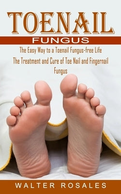 Toenail Fungus: The Easy Way to a Toenail Fungus-free Life (The Treatment and Cure of Toe Nail and Fingernail Fungus) by Rosales, Walter