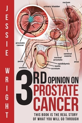 3rd Opinion on Prostate Cancer by Wright, Jessie
