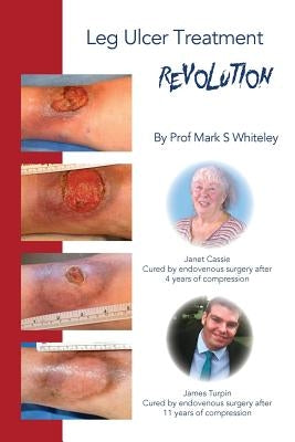 Leg Ulcer Treatment Revolution by Whiteley, Mark S.