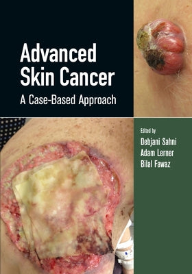 Advanced Skin Cancer: A Case-Based Approach by Sahni, Debjani